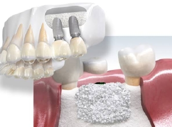 ما هي خطوات زراعة الأسنان في الفك العلوي ومميزاتها
