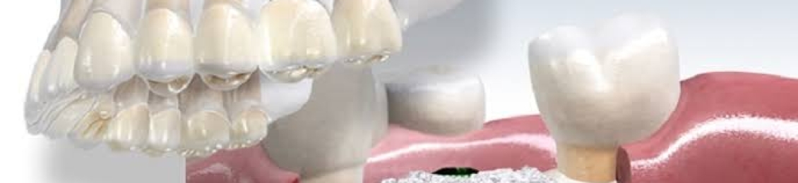 ما هي خطوات زراعة الأسنان في الفك العلوي ومميزاتها
