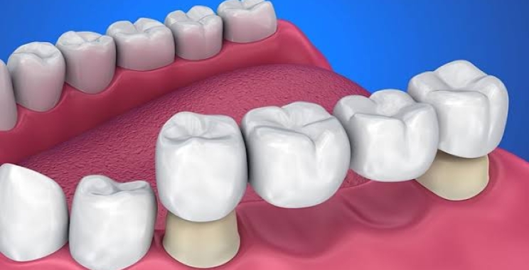 انواع تركيبات الاسنان في مجمع الطب المتميز