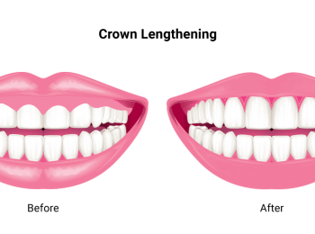 اضرار قص اللثة بالليزر قبل وبعد مع مجمع الطب المتميز