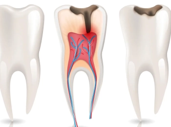 علاج اعصاب الاسنان الآلي واحدث طرق العلاج