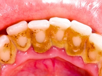 تعرف على أنواع جير الأسنان وكيفية علاجها