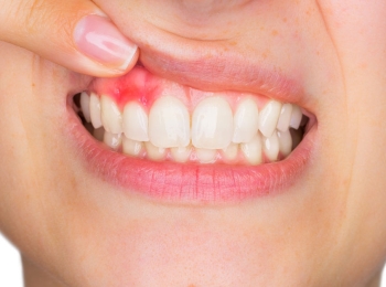  ما هو سبب انتفاخ اللثة وكيفية علاجه