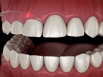 قص اللثة قبل وبعد ومميزاته مع مجمع الطب المتميز