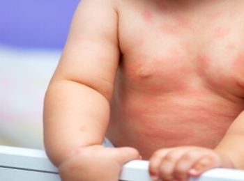ما هي حساسية الجلد من الاكل عند الاطفال وطرق علاجها
