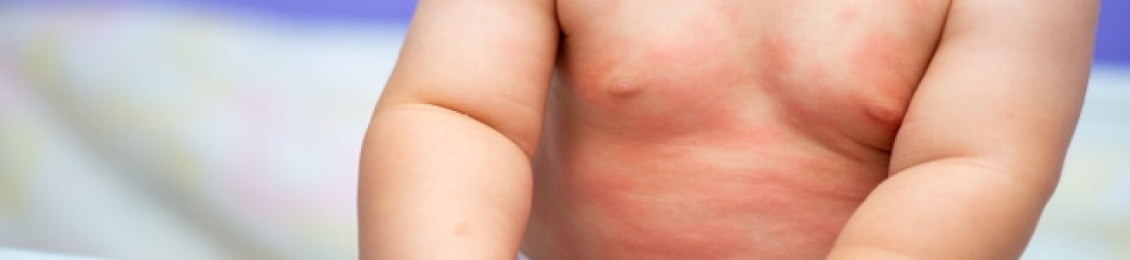 ما هي حساسية الجلد من الاكل عند الاطفال وطرق علاجها