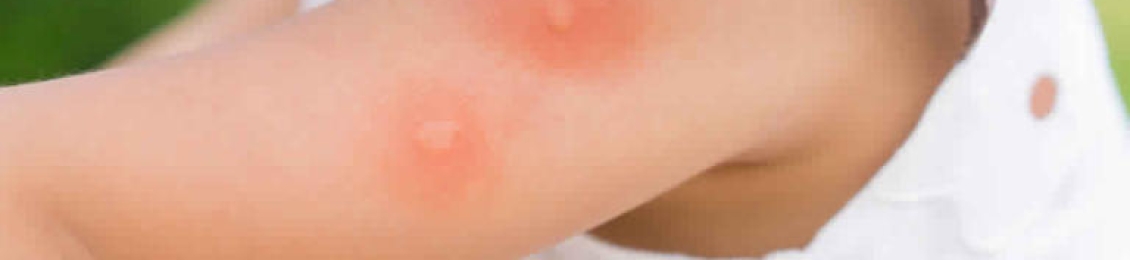 أسباب حساسية الجلد المفاجئة عند الأطفال ما هي؟