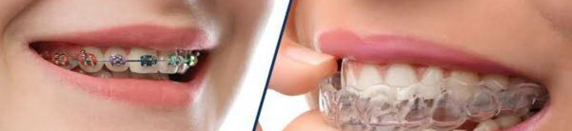 اشكال تقويم الاسنان المختلفة وكيف تختار المناسب؟