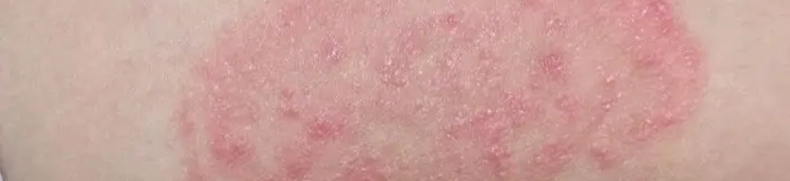 ما هي أنواع الفطريات الجلدية وطرق الوقاية منها
