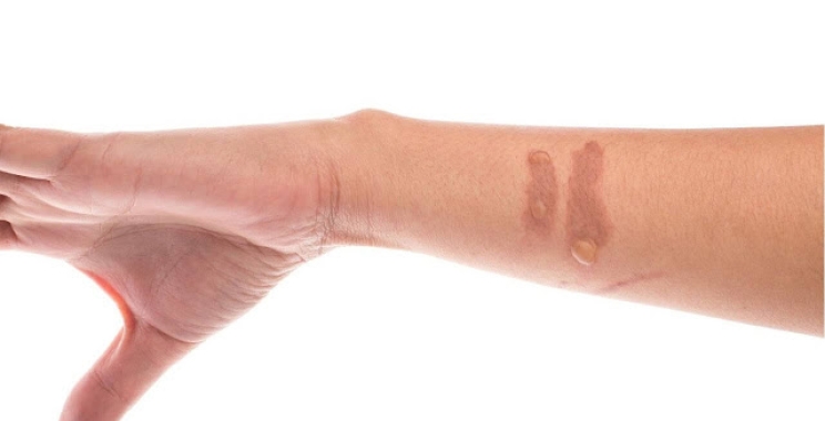ازالة علامات الحروق وما هي أهم وأحدث طرق علاجها وتحسين مظهر الجلد
