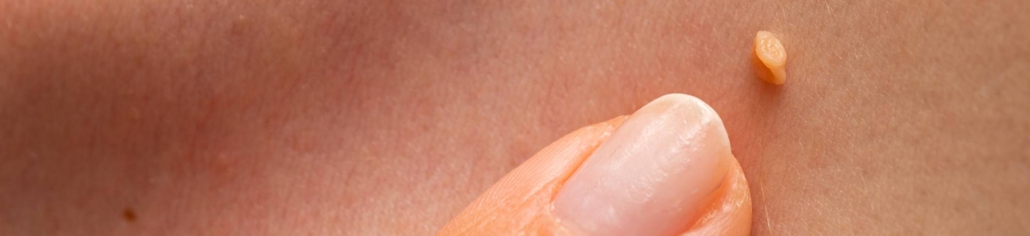 اسباب الزوائد الجلدية وأهم الأمراض التي ترتبط بها