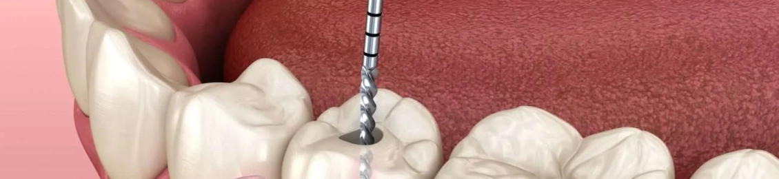 اسعار حشو الاسنان التنافسية في مجمع الطب المتميز المدينة المنورة