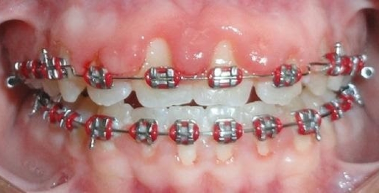 ما هي أضرار تقويم الأسنان وطرق الوقاية منها