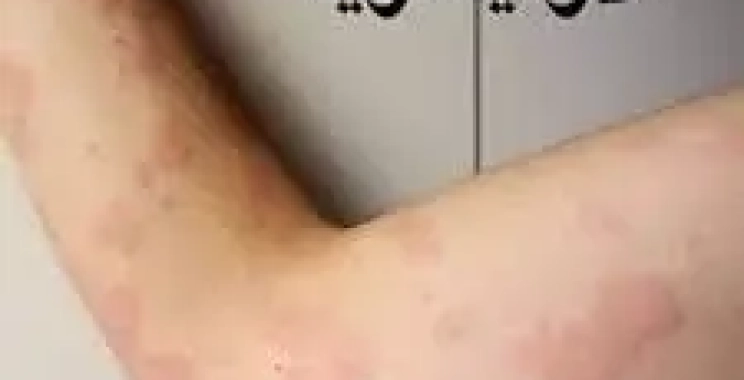 افضل دكتور لعلاج حساسية الجلد والوقاية منها