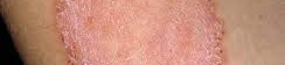 ما هي التهابات الجلد الفطرية واسبابها
