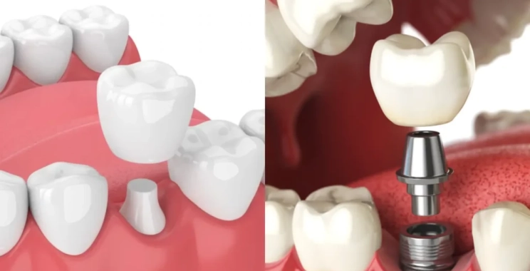 الفرق بين زراعة الاسنان والتركيب في مجمع الطب المتميز