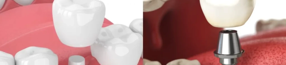 الفرق بين زراعة الاسنان والتركيب في مجمع الطب المتميز
