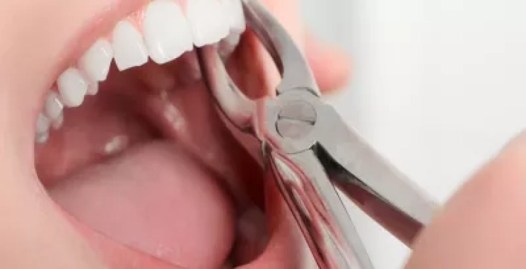 ما هي المدة بين خلع السن والتركيب المناسبة؟
