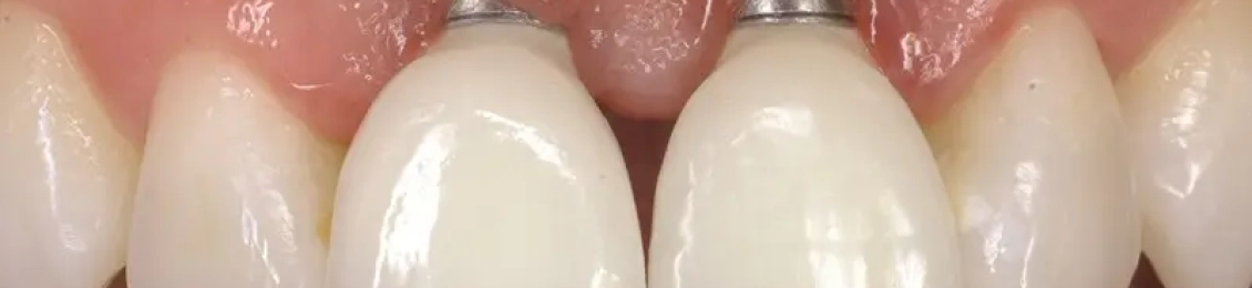 ما هي التعليمات بعد زراعة الاسنان اليوم الاول؟