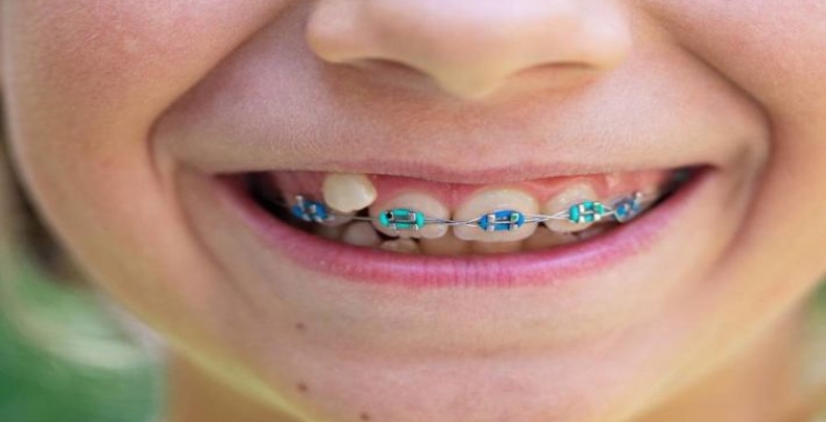 تعرف على أنواع تقويم الأسنان للاطفال وومميزاته