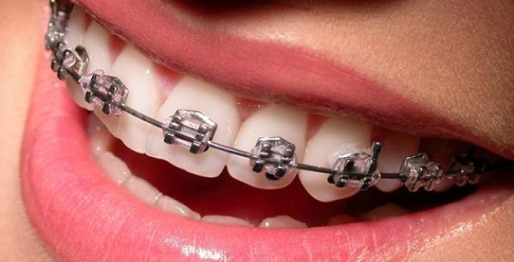 ما هي شروط تركيب تقويم الأسنان وكيفية التركيب؟