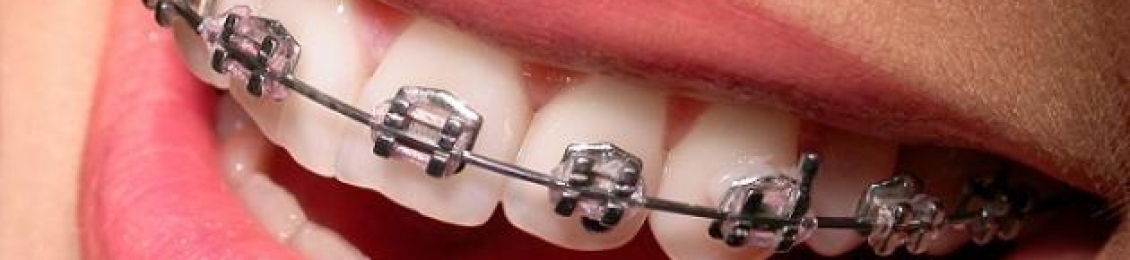 ما هي شروط تركيب تقويم الأسنان وكيفية التركيب؟