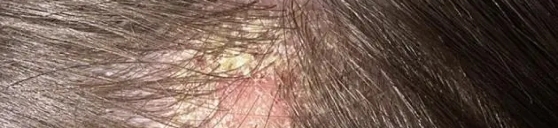 نصائح من تجربتي مع فطريات الشعر والعلاج الفعال