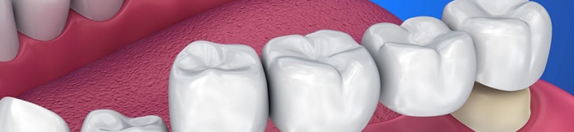 انواع تركيبات الاسنان الثابتة وفوائدها