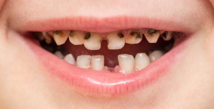 أهم اسباب تسوس الاسنان للاطفال عند عمر السنة