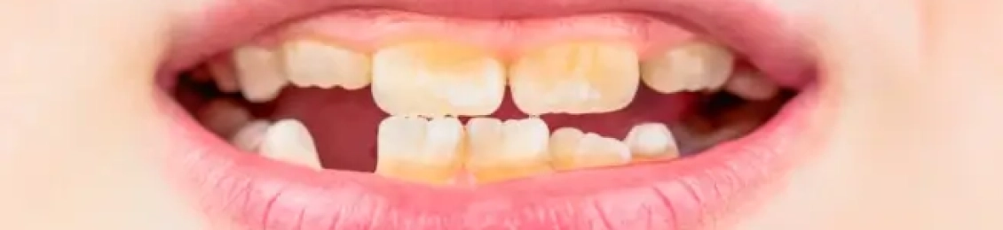 ما هو علاج تصبغات اسنان الاطفال؟