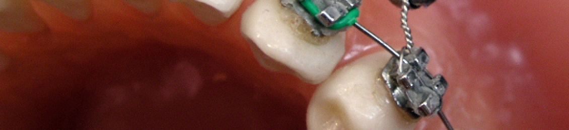 تقويم الأسنان braces مميزاته وطريقة تركيبه