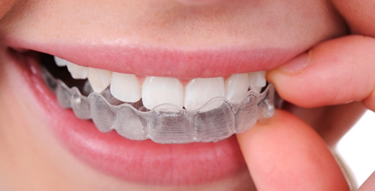 ما هو تقويم الأسنان الشفاف وكيفية تركيبه في مجمع الطب المتميز   