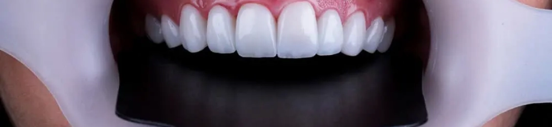 تكلفة ابتسامة هوليود وما هي مميزاتها للفم والأسنان بالتجربة العملية