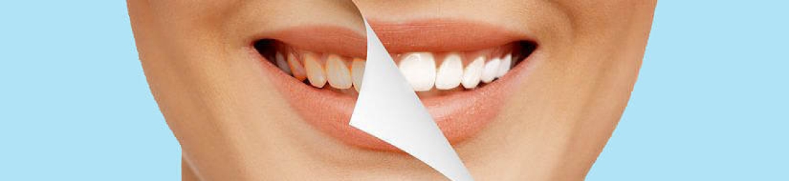 تكلفة تلميع الاسنان وكيف يتم تحديدها وأهمية إجراء التنظيف