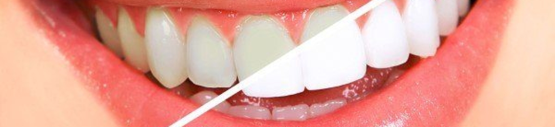 تنظيف وتلميع الاسنان ما هي التكلفة المتوقعة وأهميته للعناية بصحة الفم