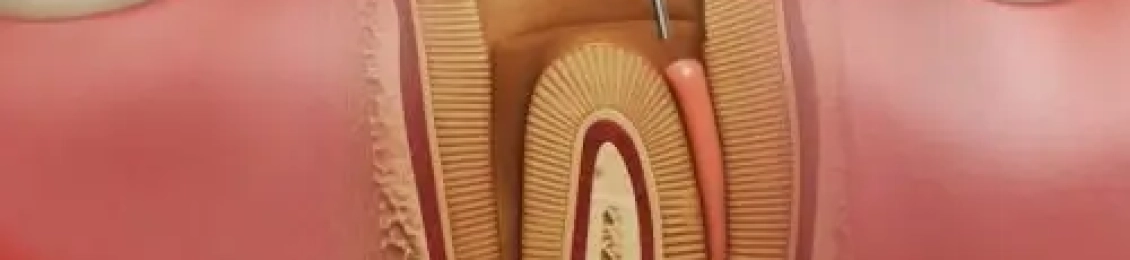 ما هو حشو عصب الاسنان وانواعه في مجمع الطب المتميز