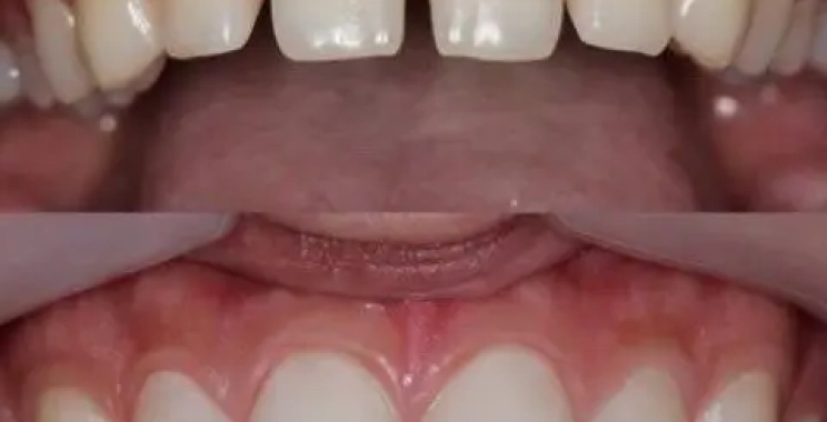 حشوة تجميلية للاسنان الامامية ومزاياها