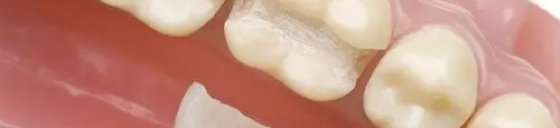 ما هي افضل حشوه للاسنان الامامية في المدينة المنورة؟