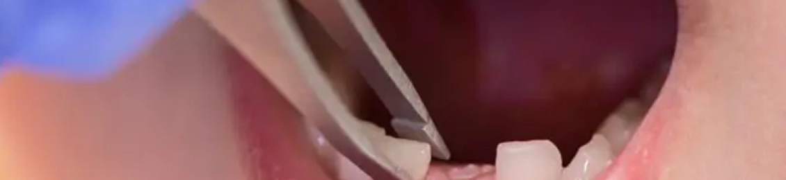 ما هي افضل النصائح والدواعي عند خلع الأسنان اللبنية المسوسة