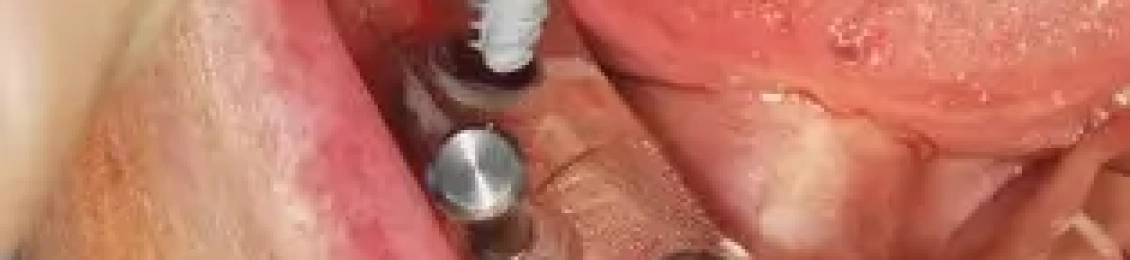 مراحل زراعة الأسنان بدون جراحة مع د.محمد بشار