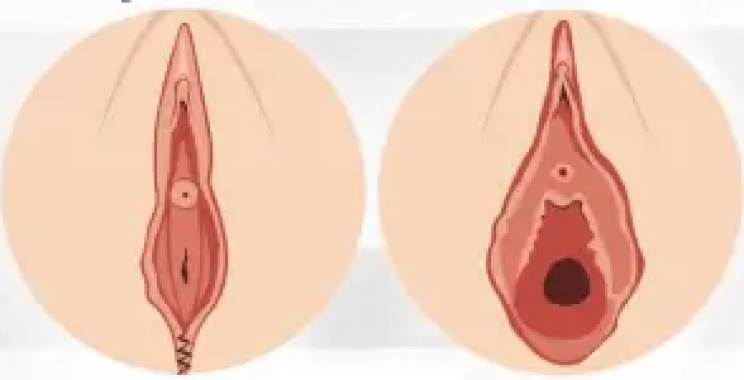 شكل المهبل بعد الخياطه التجميليه