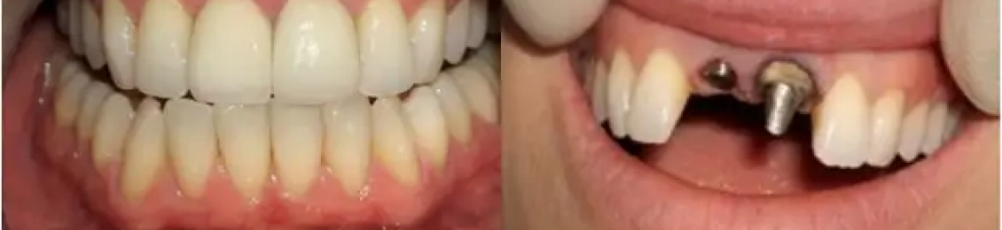 ما هي طريقة زراعة الأسنان الأمامية مع د.محمد بشار