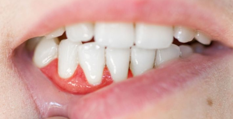 تعرف على علاج التهاب اللثة الفعال مع مجمع الطب المتميز