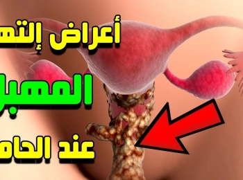 علاج التهابات المهبل للحامل: طرق آمنة ومجربة