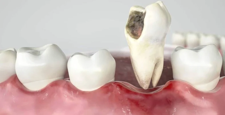 علاج الضرس المحفور الملتهب: خطوات العلاج والأدوية الموصى بها