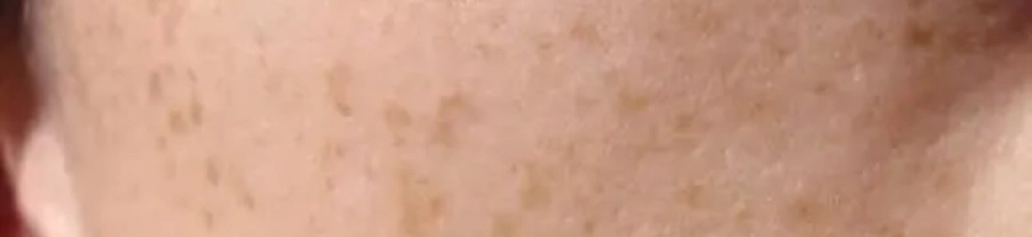 افضل طريقة علاج فطريات الجلد البنية مع د.زينب جلال