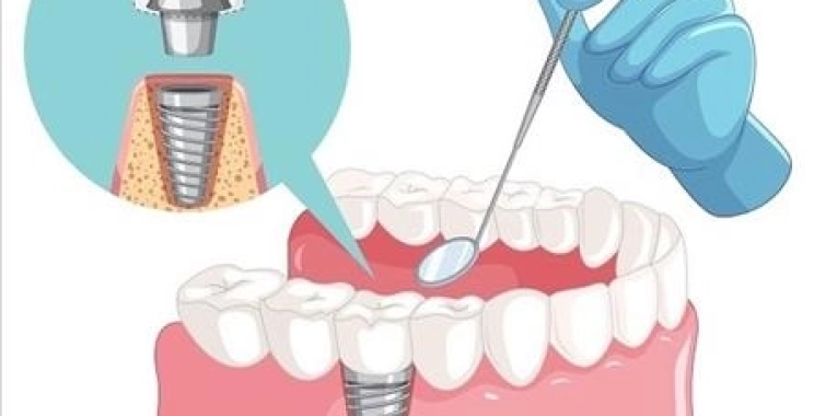 كيف اعرف نجاح زراعة الأسنان بعد العملية؟