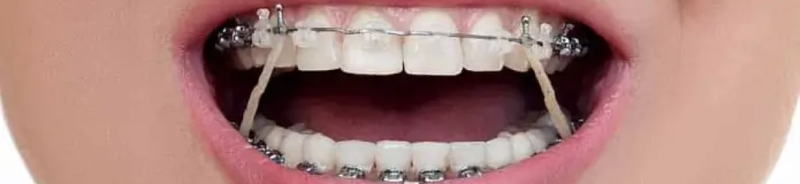 كيف يشدون تقويم الأسنان؟ ولماذا؟