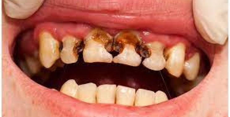 اسباب تسوس الاسنان وطرق الوقاية منها 