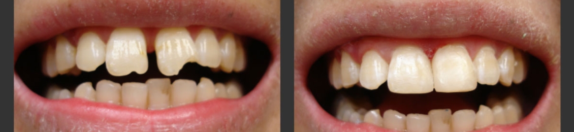 أهم عيوب تجميل الأسنان وكيفية الوقاية منها